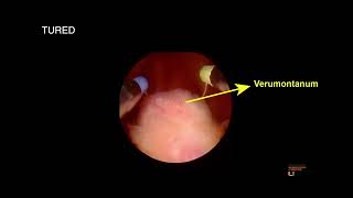 Transurethral Resection of Ejaculatory Ducts a Step by Step Guide [upl. by Antonie]