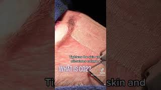 CO2 Laser Resurfacing The Best Way to Save Your Skin [upl. by Freedman55]