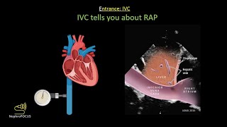 Focused cardiac ultrasound FoCUS for the Nephrologist core pathologies  Dr Koratala NephroP [upl. by Enihpets]