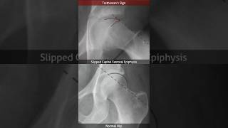 Slipped Capital Femoral Epiphysis Trethowan’s sign [upl. by Whitten]