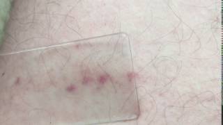 Glass test  Meningitis rash [upl. by Elata811]