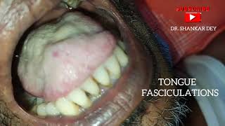 Tongue Fasciculations  Motor Neuron Disease  Amyotrophic Lateral Sclerosis  Dr Shankar Dey [upl. by Norred]