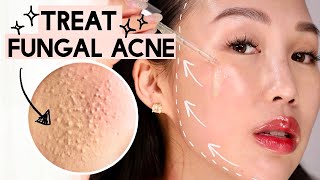 How to Get Rid of Acne Textured Skin Rid of Bumps 😡 Korean Skincare to Treat Fungal Acne [upl. by Matilda]