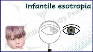 Infantile Esotropia Simplified 1│Understanding Various Phenomena amp Differential Diagnosis [upl. by Hgieliak]