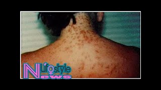 Sea Lice Outbreak Causing Discomfort On Beaches [upl. by Novyak]