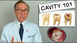 What Causes Tooth Decay Cavity 101  Causes  Treatment [upl. by Dnaltiac]