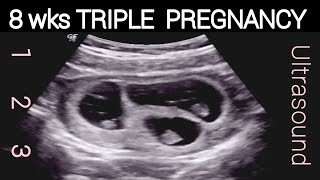 8wks TRIPLE PREGNANCY  Ultrasound [upl. by Avonasac]