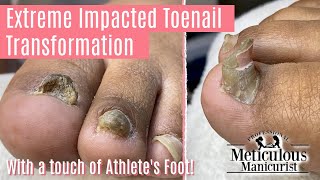 👣How to Pedicure on Extreme Impacted Toenail with Major Transformation 👣 [upl. by Aicilanna]