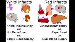 Infarcts Red vs Pale [upl. by Caundra]