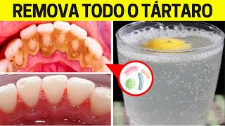 Basta Só Isto Nos DENTES Para REMOVER O TÁRTARO Sem Gastar Quase Nada [upl. by Flosser163]