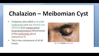 Ophthalmology 376 Chalazion Meibomian Cyst triamcinolone DIATHERMY tetracycline MALIGNANCY Eyelid [upl. by Nert]