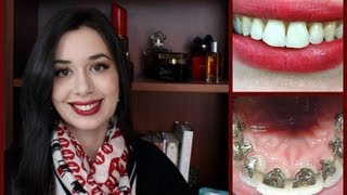 • Incognito Lingual Braces Treatment Final Reveal and Review [upl. by Netnilc]