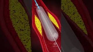 How Does Coronary Angioplasty Work  Blocked Arteries Treatment shorts  creativelearning3d [upl. by Drucilla]