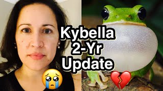 KYBELLA RESULTS 2 YEARS LATER  Before amp After Kybella Injections [upl. by Merlina]