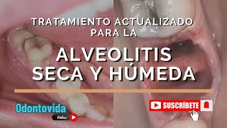 Tratamiento Actualizado para la Alveolitis Seca y Húmeda Limpieza Medicación y Apósitos [upl. by Blunt]