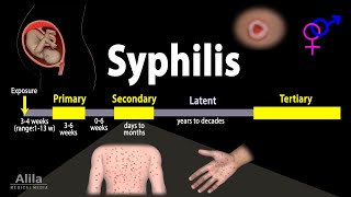 Syphilis  Pathophysiology Diagnosis and Treatments Animation [upl. by Jaenicke168]