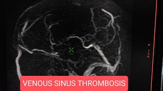 Venous sinus thrombosis on Head MRI [upl. by Reilly531]