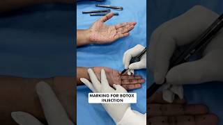 Botox Treatment for Palmar Hyperhidrosis at Skinaa Clinic viral shorts [upl. by Foulk]