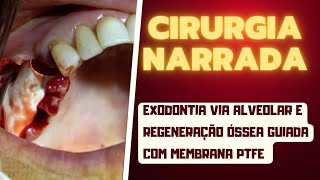 Cirurgia narrada exodontia via alveolar e regeneração óssea guiada com membrana PTFE [upl. by Llehsad]