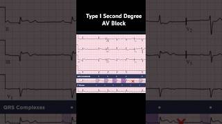 AV Block 2nd degree Mobitz I Wenckebach Phenomenon [upl. by Narton778]