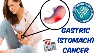 Gastric Cancer Stomach Adenocarcinomas Lymphomas GISTs And Carcinoids [upl. by Nordek]