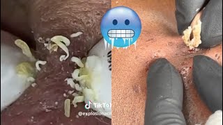 Ultimate Blackheads amp Whiteheads Removal Compilation  Best Pimple Popping amp Skincare Tips [upl. by Oznole]