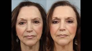 Female Blepharoplasty Before and After by Dr Edwin Williams [upl. by Oinesra]