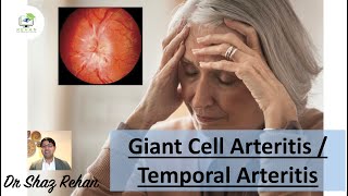 Giant Cell Arteritis GCA  Temporal Arteritis  All You Need to Know I Dr Shaz Rehan 2022 [upl. by Ynohtnacram]