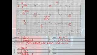 12 Lead Interpretation Part 52 Chamber Enlargements and Hypertrophies [upl. by Savina]