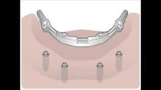 Implantatlösung für zahnlose Kiefer XiVE TG und CADCAM [upl. by Fen]