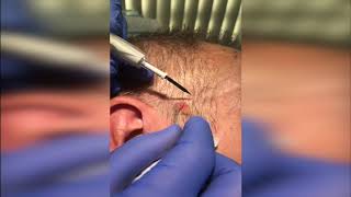 Seborrhoeic Keratosis Removal Demo [upl. by Delwin735]