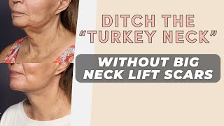 TZ Plasty Update Tightening Necklines for Men amp Women [upl. by Youlton963]