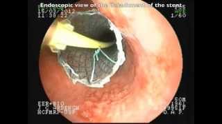 Positioning without fluorscopic esophageal SEMS [upl. by Dadelos]