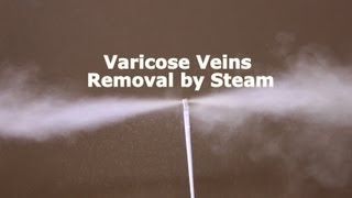 Varicose Vein Removal by Steam Vein Sclerosis from CermaVein [upl. by Martinsen]