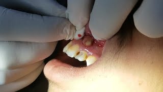 DentoAlveolar Abscess Drainage [upl. by Asirap]