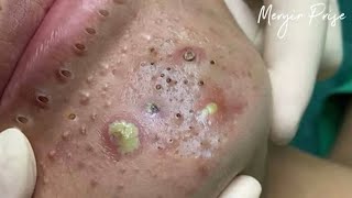 Big Cystic Acne Blackheads Extraction Blackheads amp Milia Whiteheads Removal Pimple Popping [upl. by Bose]