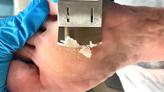 Callus removal from feetampFoot scraping dead skin【Xiao Yan pedicure】stress 39 [upl. by Kinney]