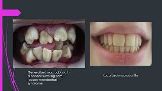 All you need to know about macrodontiaBig teeth by DrAmin [upl. by Kawai]