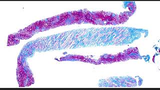 Collidescope Ep 1  What happens when IgA nephropathy and fibrillary glomerulopathy collide [upl. by Elleinet]