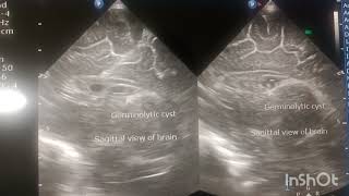 GErminal matrix hemorrhage Germinolytic cyst Connatal Cyst [upl. by Odlaw]