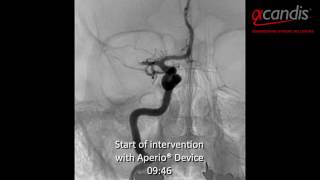 Acute ischaemic stroke treatment Acandis Aperio® Thrombectomy Device [upl. by Reniti]