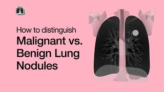 Distinguish Malignant vs Benign Lung Nodules [upl. by Gaal]