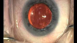 istent for glaucoma [upl. by Onibas]