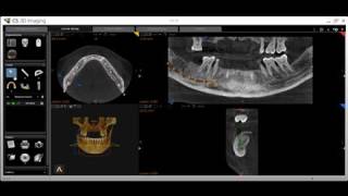 CS 3D Imaging Implant Evaluation and Placement [upl. by Tegan]