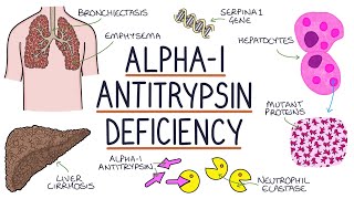 Understanding Alpha1 Antitrypsin Deficiency [upl. by Leatri]