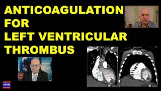 Management of LEFT VENTRICULAR Thrombus by DR NIK NIKAM 2024 [upl. by Graces]