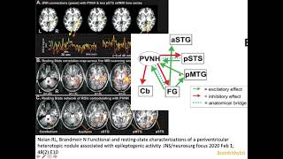 7 Heterotopia epilepsy PVNH malformation cortical development filamin CDK5 MRI neuroradiology [upl. by Benzel791]