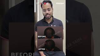 Crown Hair Loss Amazing Results in Just 3 Months  HairMd Clinic Pune [upl. by Echikson]