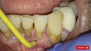 How a Dentist Performs Gingivoplasty Technique by Dental Electrocautery  Dental Cautery Procedure [upl. by Endres553]