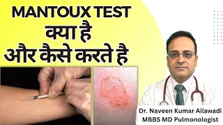 Mantoux Test क्या है और कैसे करते है  Mantoux tuberculin skin test TST TB Test  Diagnosis of TB [upl. by Ahsinnod573]